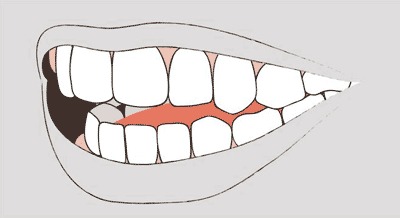 Grafik einer Zahnfehlstellung