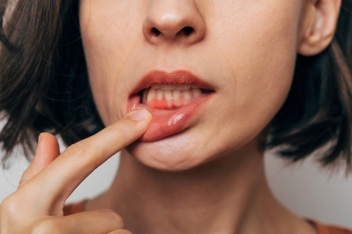 Nahaufnahme des Mundes einer jungen Frau mit gerötetem und blutendem Zahnfleisch.